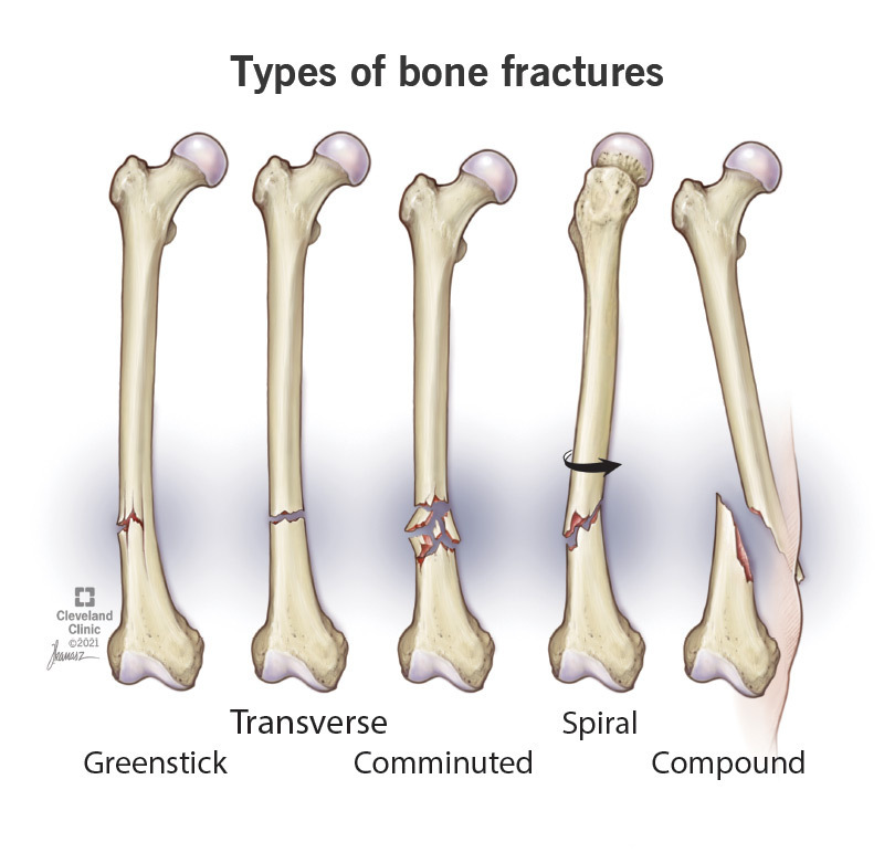 Spiral fractures twist around bones.
