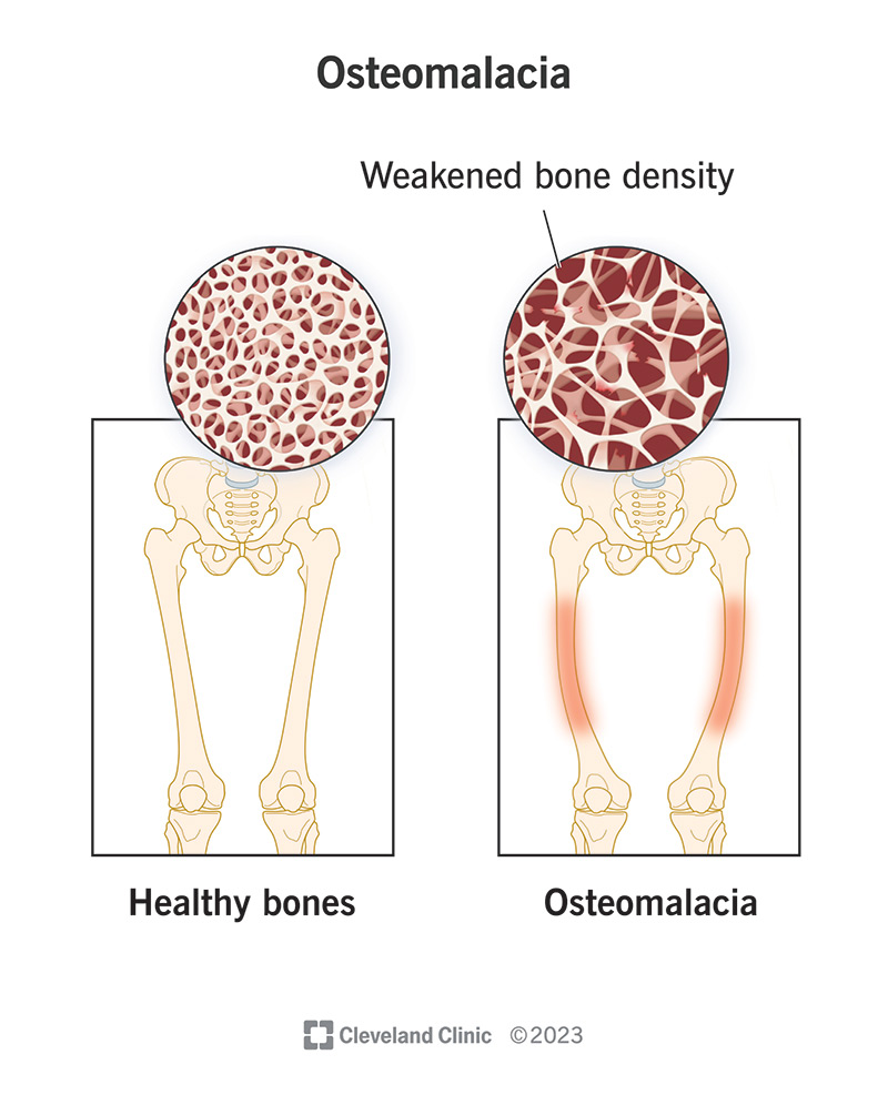 Comparing healthy bones with bones with osteomalacia (weakened bone density).